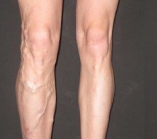 La varicosis progresa rápidamente