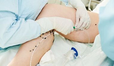 Métodos para el tratamiento de las venas varicosas en las piernas en mujeres