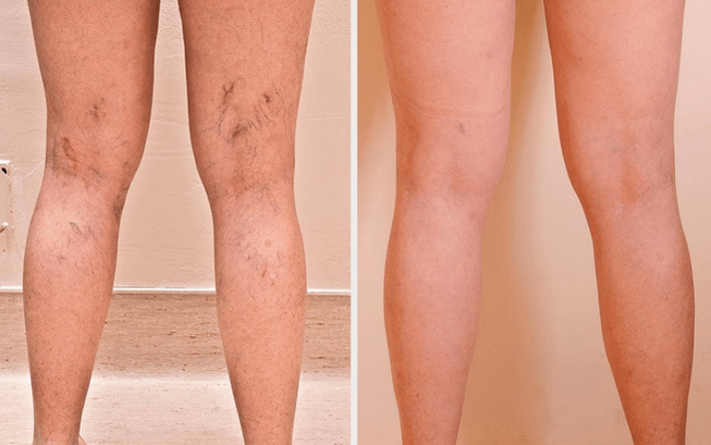 piernas antes y después del tratamiento para las venas varicosas