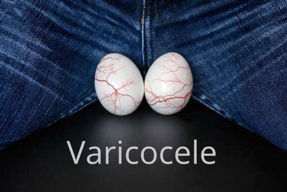 Varicocele dilatación de las venas del cordón espermático.